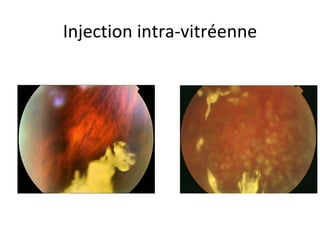 Injection intra-vitréenne
