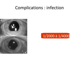 Complications : infection 1/2000 à 1/4000