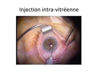 Injection intra-vitréenne 