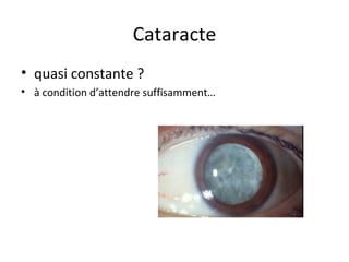 Cataracte ,[object Object],[object Object]