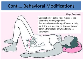 Cont…. Behavioral Modifications
Contraction of pelvic floor muscle is the
best done when lying down.
But it can be done during different activity
as sitting in a meeting or stopping in your
car in a traffic light or when talking in
telephone.
 