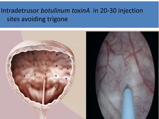 Intradetrusor botulinum toxinA in 20-30 injection
sites avoiding trigone
 
