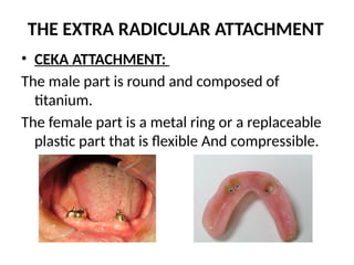 THE EXTRA RADICULAR ATTACHMENT
• CEKA ATTACHMENT:
The male part is round and composed of
titanium.
The female part is a metal ring or a replaceable
plastic part that is flexible And compressible.
 