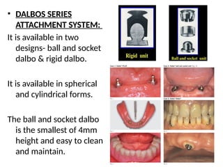 • DALBOS SERIES
ATTACHMENT SYSTEM:
It is available in two
designs- ball and socket
dalbo & rigid dalbo.
It is available in spherical
and cylindrical forms.
The ball and socket dalbo
is the smallest of 4mm
height and easy to clean
and maintain.
 
