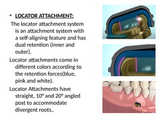 • LOCATOR ATTACHMENT:
The locator attachment system
is an attachment system with
a self-aligning feature and has
dual retention (inner and
outer).
Locator attachments come in
different colors according to
the retention forces(blue,
pink and white).
Locator Attachments have
straight, 10° and 20° angled
post to accommodate
divergent roots..
 