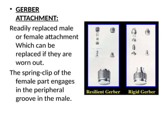 • GERBER
ATTACHMENT:
Readily replaced male
or female attachment
Which can be
replaced if they are
worn out.
The spring-clip of the
female part engages
in the peripheral
groove in the male.
 