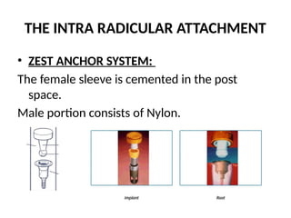 THE INTRA RADICULAR ATTACHMENT
• ZEST ANCHOR SYSTEM:
The female sleeve is cemented in the post
space.
Male portion consists of Nylon.
 
