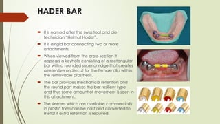 Over-Dentures and Attachments.pptxxxxxxx | PPTX