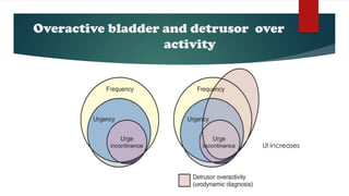 Overactive bladder and detrusor over
activity
UI increases
 