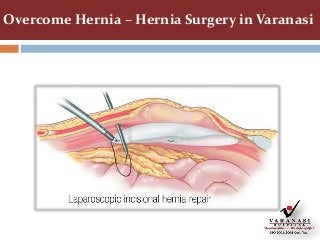 Overcome Hernia – Hernia Surgery in Varanasi
 