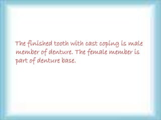 The finished tooth with cast coping is male
member of denture. The female member is
part of denture base.
 