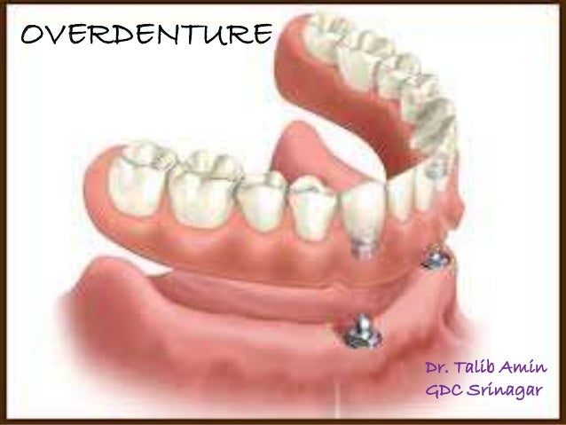 overdenture