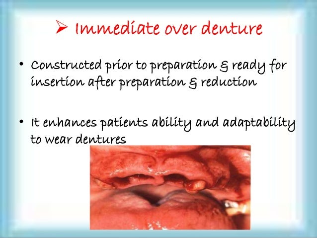 overdenture