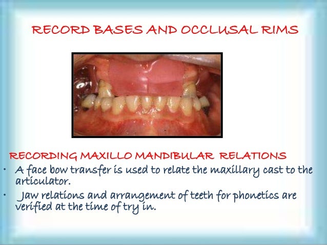 overdenture