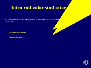 Intra radicular stud attachment
he stud is attached to the fitting surface of the denture and the housing is incorporated in the
abutment.
est anchor attachment.
- Ring attachment.
 
