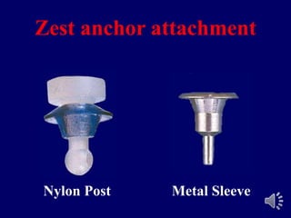Zest anchor attachment
Nylon Post Metal Sleeve
 