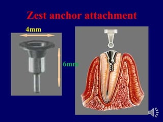 Zest anchor attachment
4mm
6mm
 