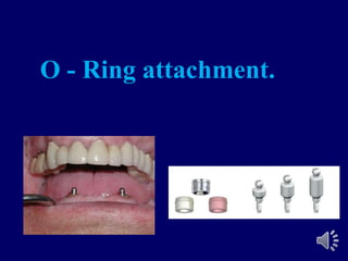 O - Ring attachment.
 
