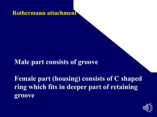 Rothermann attachment
Male part consists of groove
Female part (housing) consists of C shaped
ring which fits in deeper part of retaining
groove
 