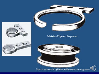 Matrix–eccentric cylinder with undercut or groove
Matrix–Clip or clasp arm
 