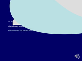 Advantages of the Rothermann
attachment:
ow in height.
t has adequate retention similar to the clasp.
he female clip is well retained in the resin.
 