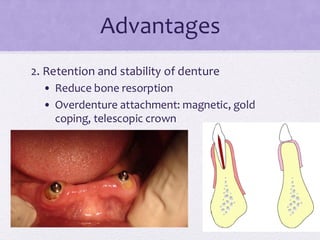 Advantages
2. Retention and stability of denture
• Reduce bone resorption
• Overdenture attachment: magnetic, gold
coping, telescopic crown
 