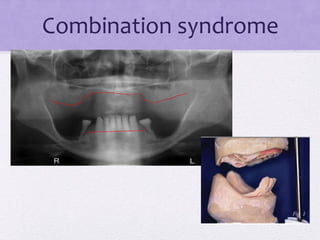 Combination syndrome
 