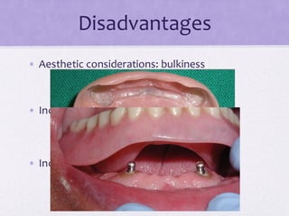 Disadvantages
• Aesthetic considerations: bulkiness
• Increase interocclusal space requirements
• Increase costs
 