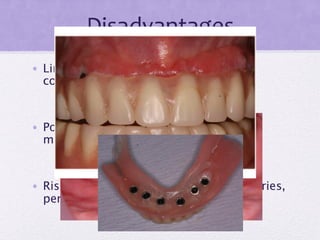 Disadvantages
• Limitation of space due to wear or
compensatory growth
• Potential for fracture of denture base
materials
• Risk of further disease of abutment: caries,
periodontal disease
 