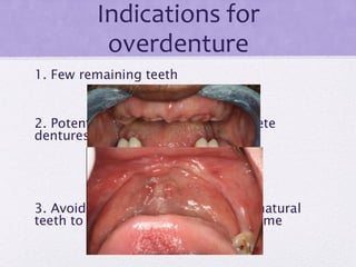 Indications for
overdenture
1. Few remaining teeth
2. Potentially difficult (lower) complete
dentures
3. Avoid edentulous arch opposing natural
teeth to prevent combination syndrome
 