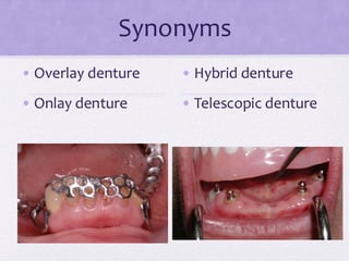 Synonyms
• Overlay denture
• Onlay denture
• Hybrid denture
• Telescopic denture
 