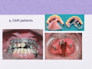 4. Cleft patients
 