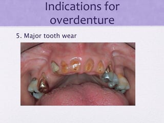 Indications for
overdenture
5. Major tooth wear
 