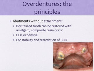 Overdentures: the
principles
• Abutments without attachment:
• Devitalized tooth can be restored with
amalgam, composite resin or GIC.
• Less expensive
• For stability and retardation of RRR
 