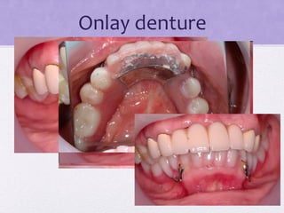 Onlay denture
 