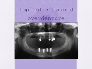 Implant retained
overdenture
 