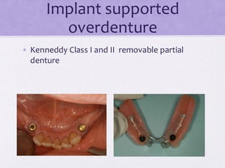 Implant supported
overdenture
• Kenneddy Class I and II removable partial
denture
 