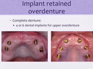 Implant retained
overdenture
• Complete denture:
• 4 or 6 dental implants for upper overdenture
 