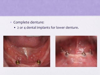 • Complete denture:
• 2 or 4 dental implants for lower denture.
 