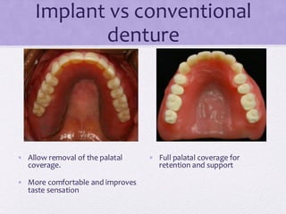 Implant vs conventional
denture
• Allow removal of the palatal
coverage.
• More comfortable and improves
taste sensation
• Full palatal coverage for
retention and support
 