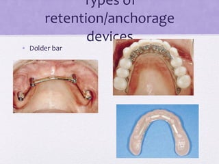 Types of
retention/anchorage
devices
• Dolder bar
 