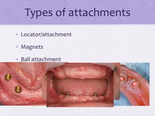 Types of attachments
• Locator/attachment
• Magnets
• Ball attachment
 