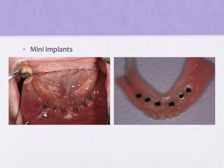 • Mini implants
 