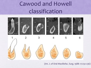Cawood and Howell
classification
(Int. J. of Oral Maxillofac. Surg. 1988: 17:232-236)
 
