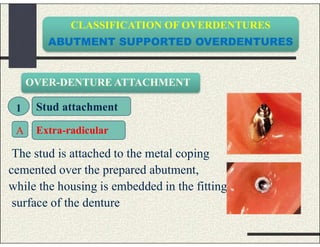 CLASSIFICATION OF OVERDENTURES
ABUTMENT SUPPORTED OVERDENTURES
The stud is attached to the metal coping
cemented over the prepared abutment,
while the housing is embedded in the fitting
surface of the denture
OVER-DENTURE ATTACHMENT
1 Stud attachment
Extra-radicularA
 