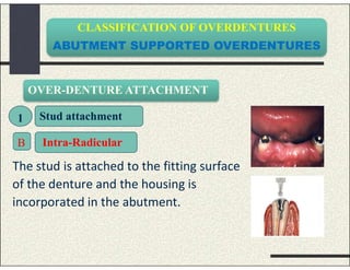 CLASSIFICATION OF OVERDENTURES
ABUTMENT SUPPORTED OVERDENTURES
The stud is attached to the fitting surface
of the denture and the housing is
incorporated in the abutment.
OVER-DENTURE ATTACHMENT
1 Stud attachment
Intra-RadicularB
 