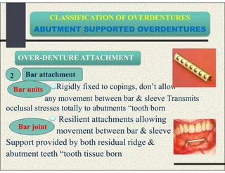 CLASSIFICATION OF OVERDENTURES
ABUTMENT SUPPORTED OVERDENTURES
Rigidly fixed to copings, don’t allow
any movement between bar & sleeve Transmits
occlusal stresses totally to abutments “tooth born
Resilient attachments allowing
movement between bar & sleeve
Support provided by both residual ridge &
abutment teeth “tooth tissue born
OVER-DENTURE ATTACHMENT
2 Bar attachment
Bar units
Bar joint
 
