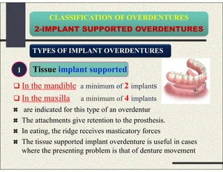 CLASSIFICATION OF OVERDENTURES
2-IMPLANT SUPPORTED OVERDENTURES
 In the mandible a minimum of 2 implants
 In the maxilla a minimum of 4 implants
are indicated for this type of an overdentur
The attachments give retention to the prosthesis.
In eating, the ridge receives masticatory forces
The tissue supported implant overdenture is useful in cases
where the presenting problem is that of denture movement
TYPES OF IMPLANT OVERDENTURES
Tissue implant supported1
 