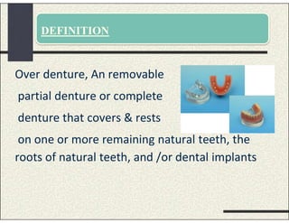 DEFINITION
Over denture, An removable
partial denture or complete
denture that covers & rests
on one or more remaining natural teeth, the
roots of natural teeth, and /or dental implants
 