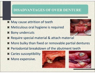 DISADVANTAGES OF OVER DENTURE
May cause attrition of teeth
Meticulous oral hygiene is required
Bony undercuts
Require special material & attach material
More bulky than fixed or removable partial dentures
Periodontal breakdown of the abutment teeth
Caries susceptibility
More expensive.
 